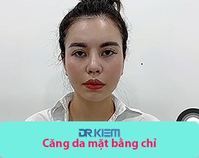 Hỗ trợ căng da mặt bằng chỉ