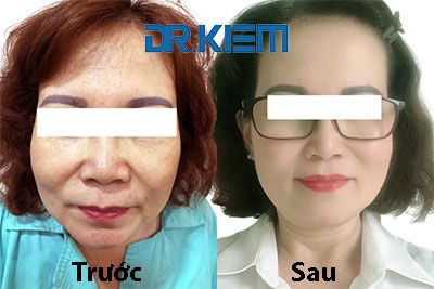 Bùng phát trứng cá mới điều trị