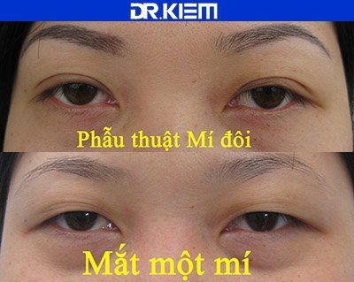 Cắt mí đôi cho người việt