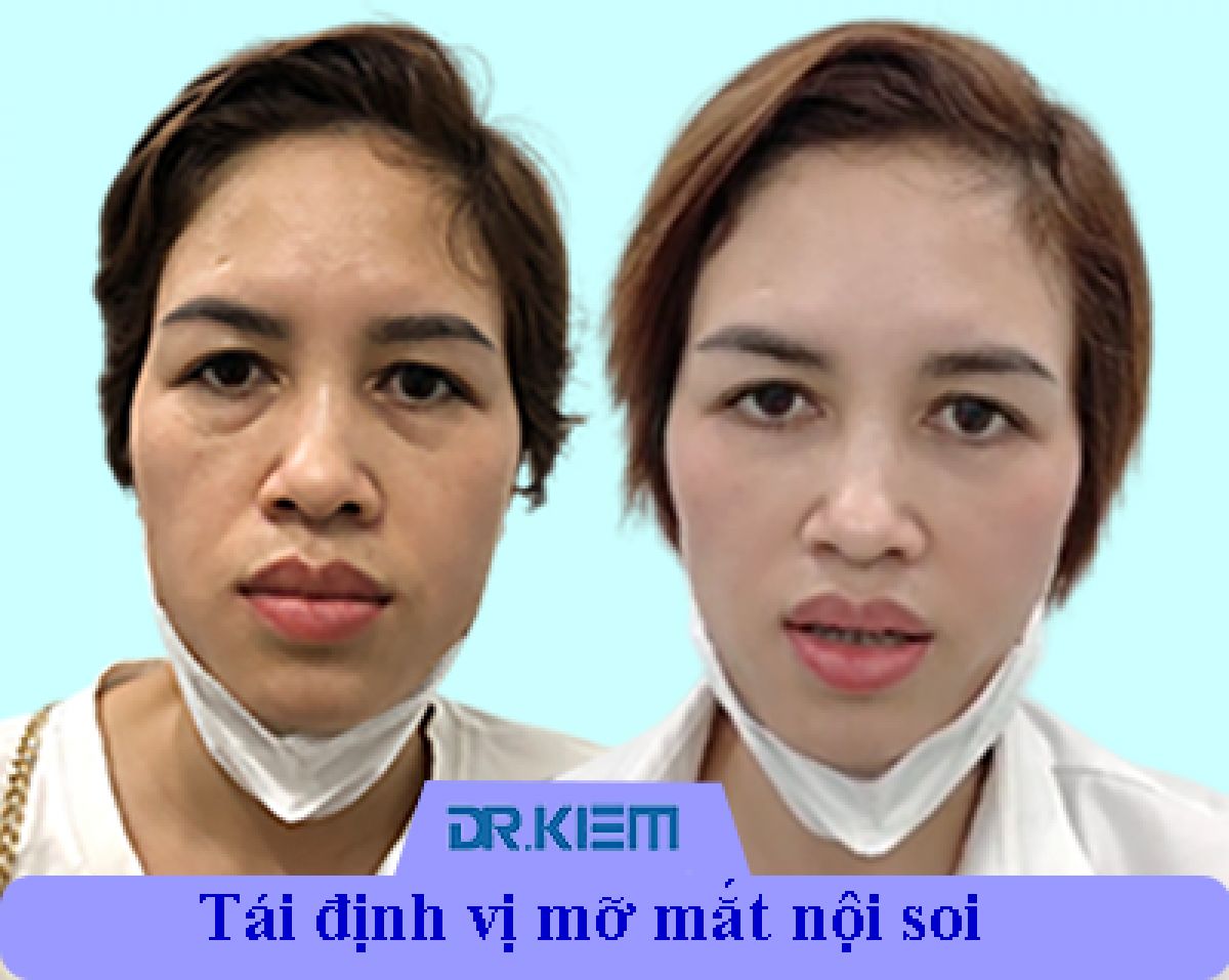 Xóa bọng mỡ mắt