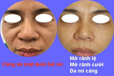 Căng da mặt dưới bờ mi