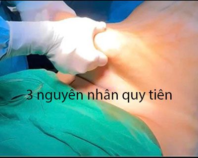 Ba nguyên nhân tử vong sau hút mỡ bụng