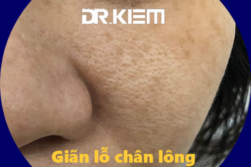 Se khít lỗ chân lông